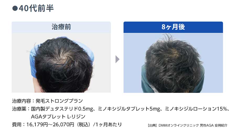 40代前半男性　発毛ストロングプラン　8か月後